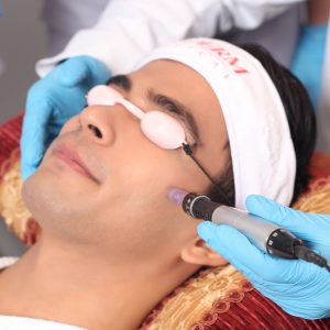 Micro-Needling