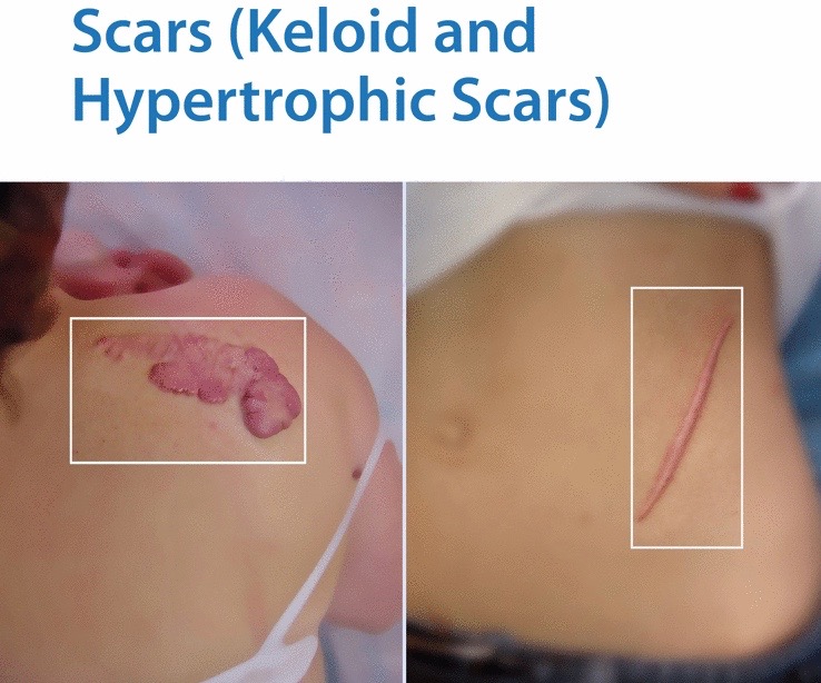 hypertrophic scar vs keloid