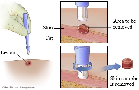 Skin Punch Biopsy  Rederm Medical Center